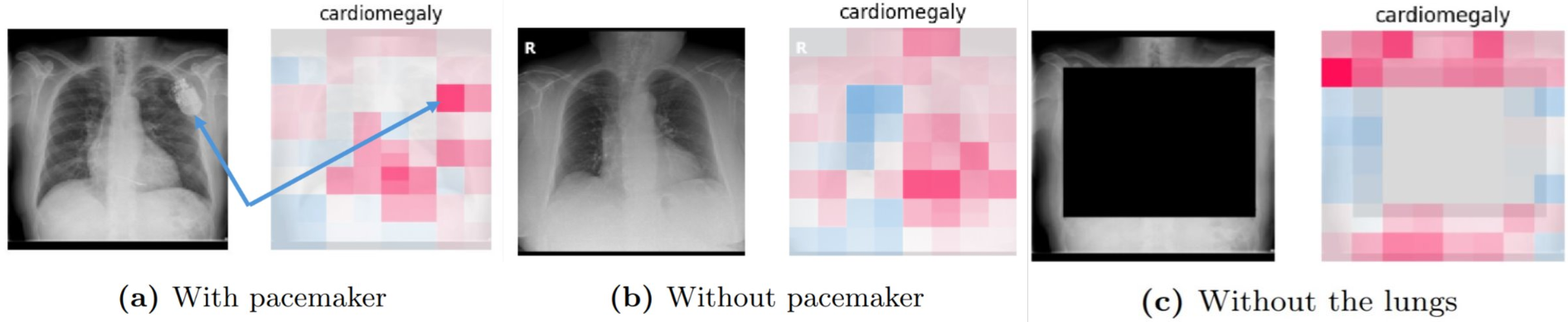 SHAP values of different chest x-rays.