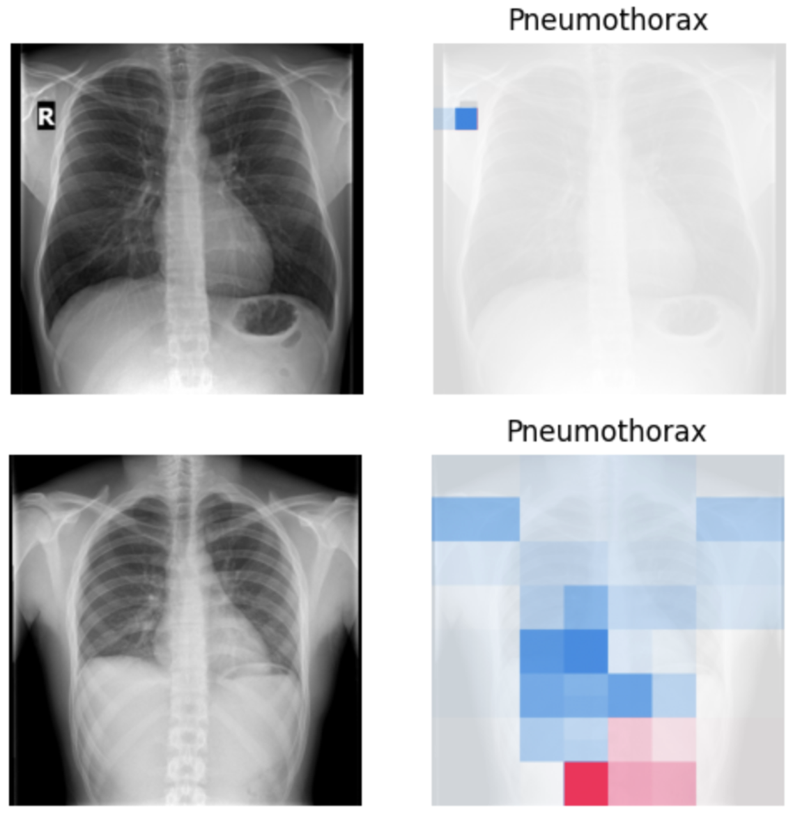 SHAP explainability maps for a positive sample from ImagingDynamics scanner and Philips scanner